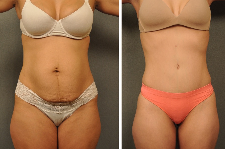 Tummy Tuck  Zimmerman Center for Plastic Surgery